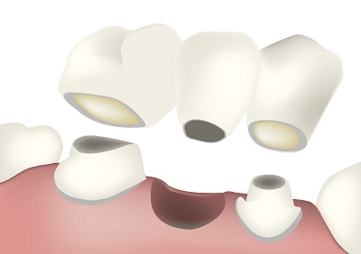 Why do you need a Dental Bridge?