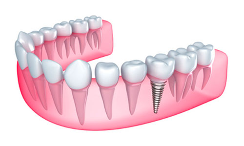 Removable or Fixed Implant Dentures