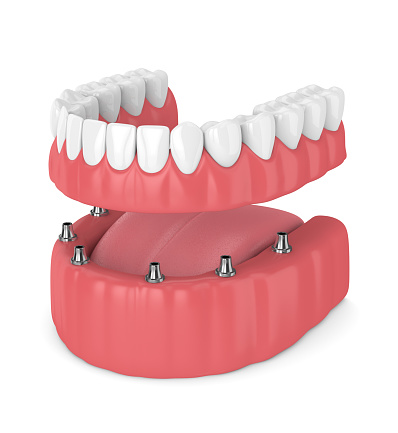 If You Get One Set of Dentures on Implants, Which Arch Should It Be?