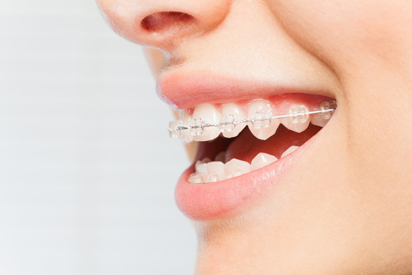 Side view of woman's smile with ceramic braces on her teeth