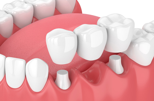 Rendering of jaw with dental bridge at Premier Dental.