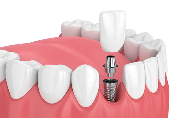 Rendering of jaw with dental implant at Premier Dental.