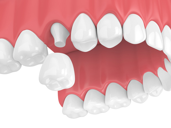 Rendering of dental crown along with upper teeth