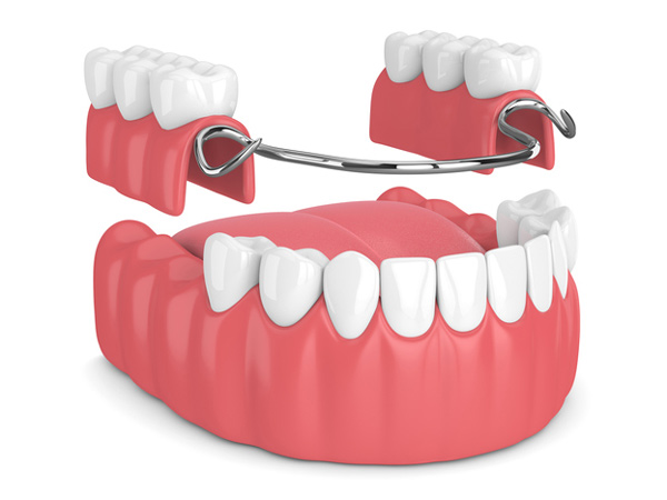 Rendering of removable partial denture