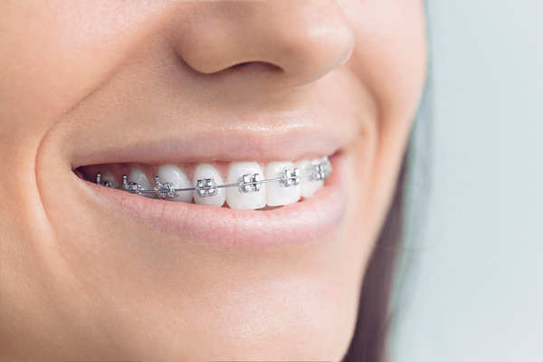 Close up of smiling woman with metal traditional braces at Premier Dental.