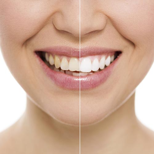 What Causes Blue or Gray Teeth?