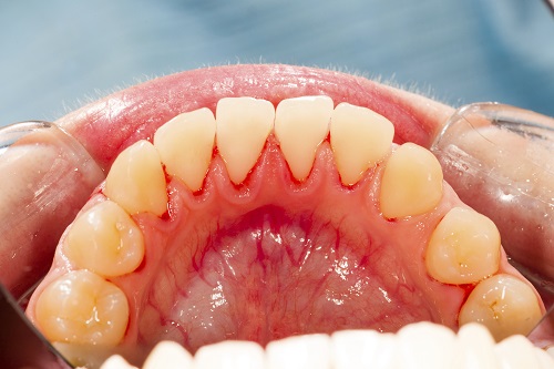 Can Cancer Be Caused By Gum Disease?
