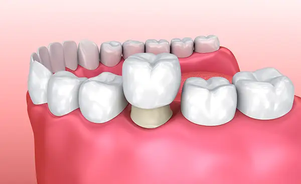 A dental crown placed on a prepared molar tooth in the gums, demonstrating a restorative dental procedure.